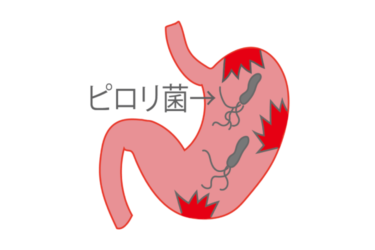 ピロリ菌感染