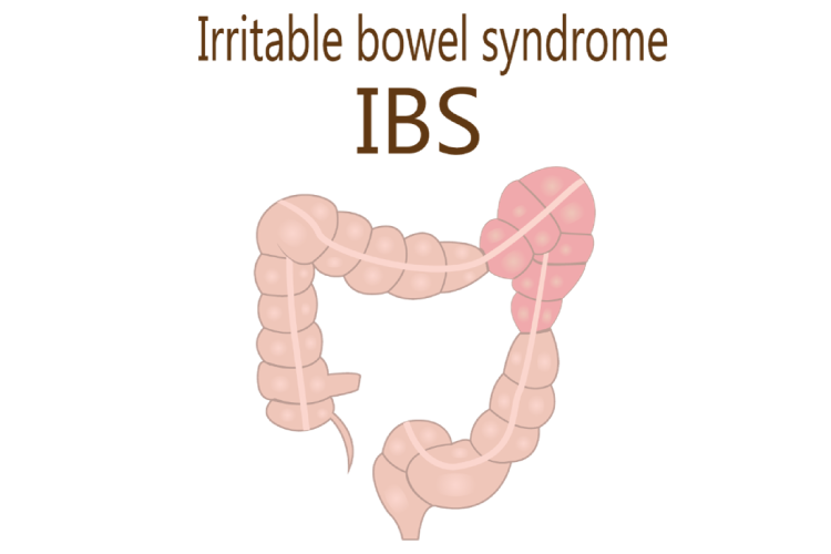 過敏性腸症候群（IBS）